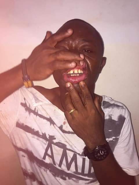 Bertrand Tsasse, a pressman working for Canal 2 TV is nursing injuries sustained from being brutalised by Municipal Police officers in Yaoundé  He was covering clashes between the municipal police agents and commercial bike riders when the Yaoundé V council agents got him